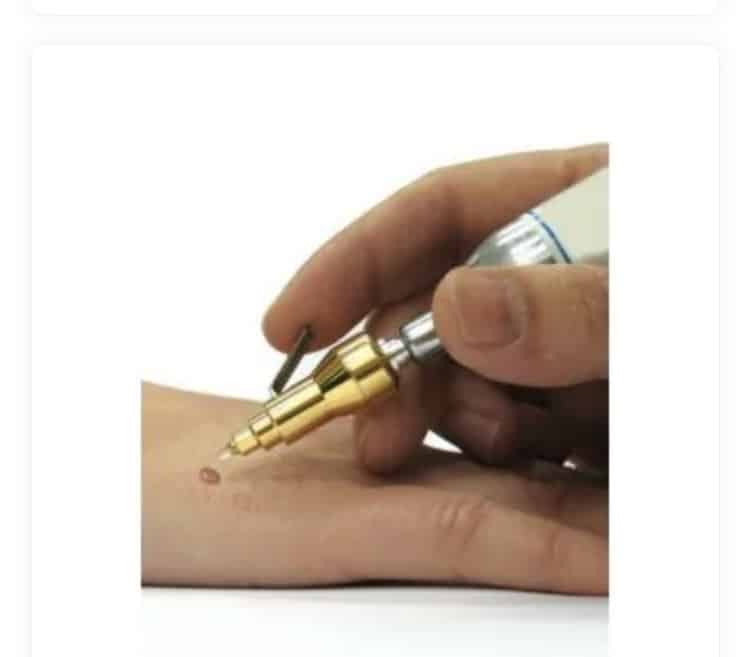 Behandeling hand met Cryo stift